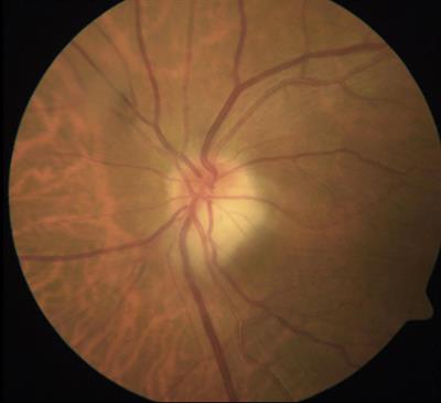 Giant Cell Arteritis: Updates and Controversies